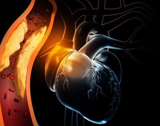 Arterial Blockage – ST-Elevation Myocardial Infarction (STEMI)