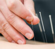 What to Expect When You Go to an Acupuncturist